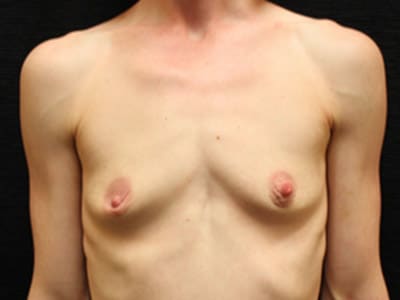 Patient #90078: Breast Augmentation Before Image