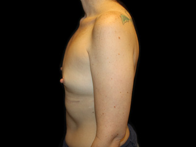 Patient #17956: Breast Implant Removal & Breast Lift After Image