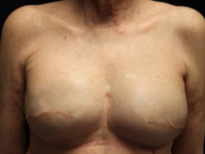 Patient #58102: Breast Reconstruction with Latissimus Flap After Image
