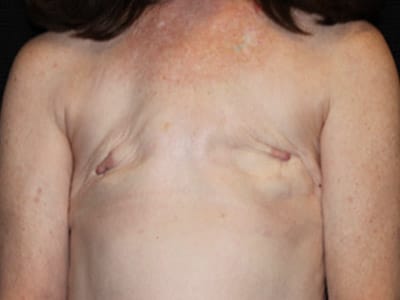 Patient #58102: Breast Reconstruction with Latissimus Flap Before Image