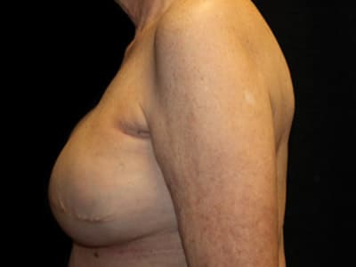 Patient #58102: Breast Reconstruction with Latissimus Flap After Image