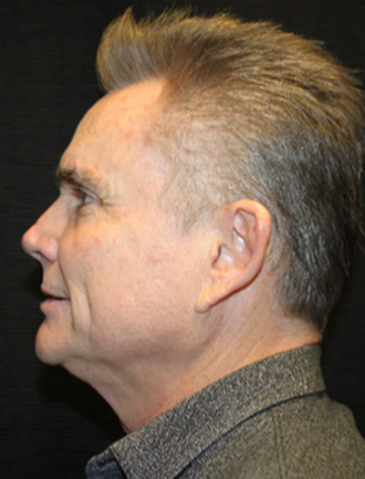 Patient #25367: FaceTite After Image