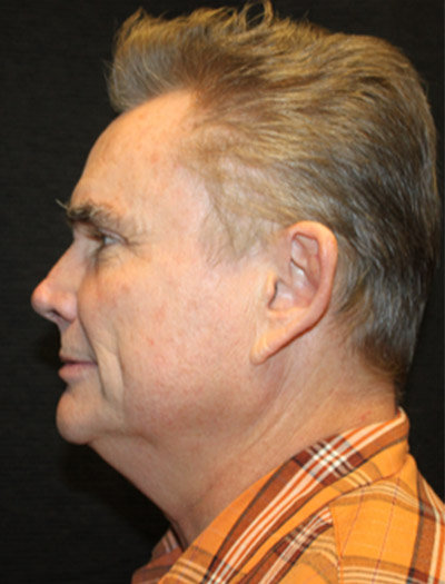Patient #25367: FaceTite Before Image