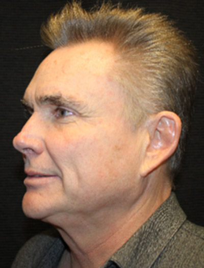 Patient #25367: FaceTite After Image