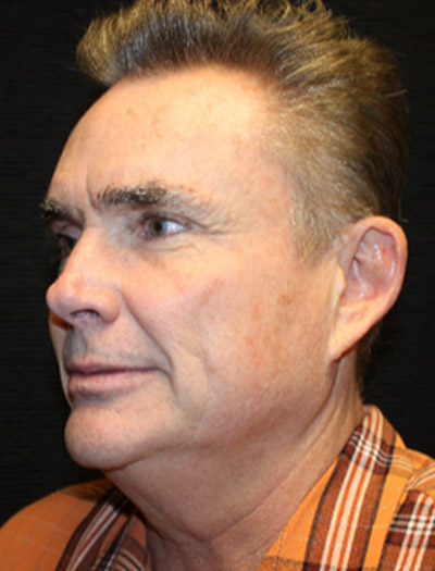 Patient #25367: FaceTite Before Image