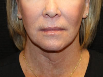 Patient #77943: FaceTite After Image