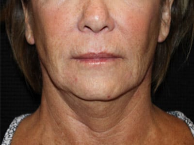 Patient #77943: FaceTite Before Image