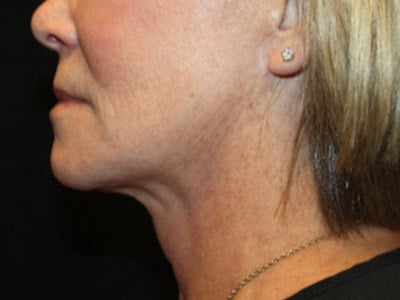 Patient #77943: FaceTite After Image