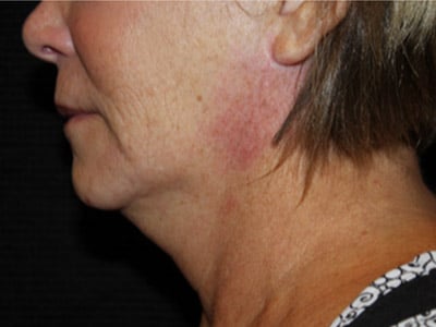 Patient #77943: FaceTite Before Image