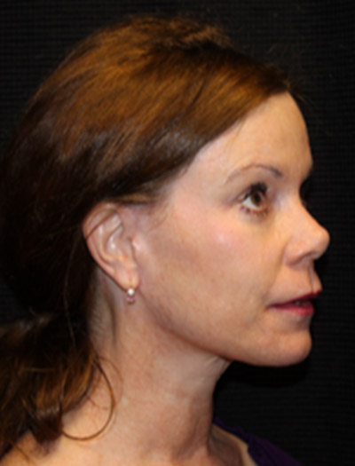 Patient #51971: Facelift & Neck Lift After Image