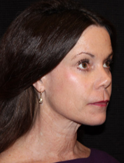 Patient #51971: Facelift & Neck Lift Before Image