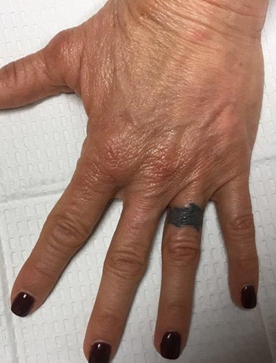 Patient #16805: Hand Rejuvenation After Image