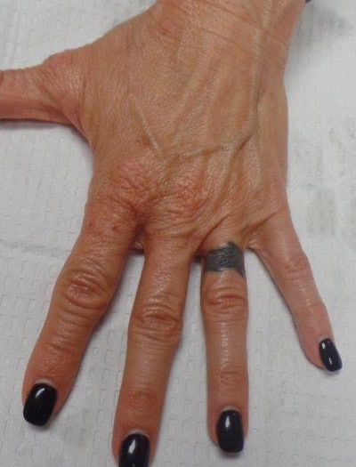 Patient #16805: Hand Rejuvenation Before Image
