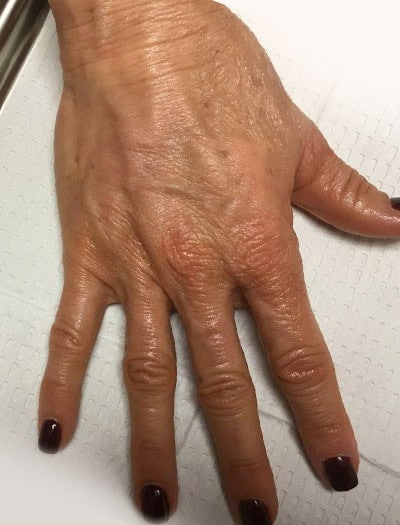 Patient #16805: Hand Rejuvenation After Image