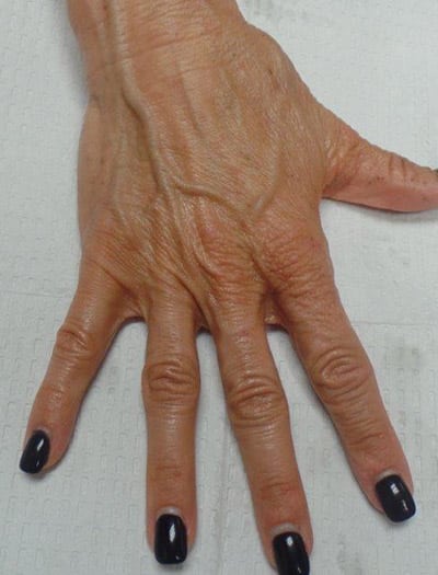 Patient #16805: Hand Rejuvenation Before Image
