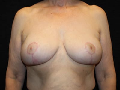 Patient #47693: Breast Augmentation & Breast Lift After Image