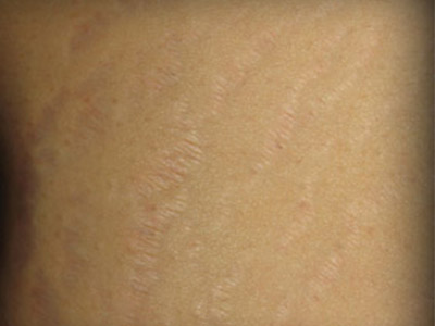 Patient #25054: Stretch Marks After Image