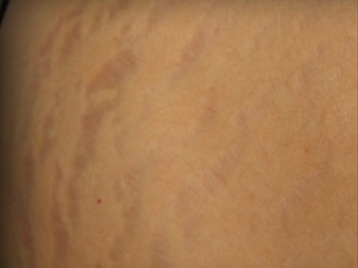 Patient #25054: Stretch Marks Before Image