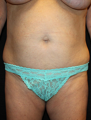 Patient #33115: Tummy Tuck Before Image