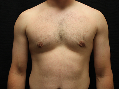Patient #38420: Gynecomastia After Image