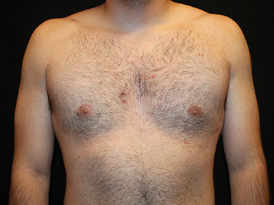 Patient #28706: Gynecomastia After Image