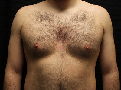 Patient #28706: Gynecomastia Before Image