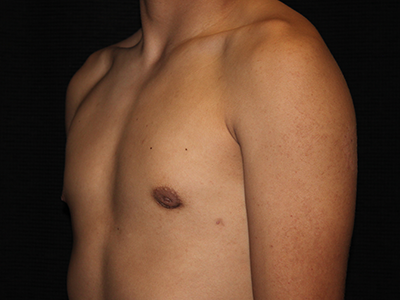Patient #30815: Gynecomastia with Liposuction After Image