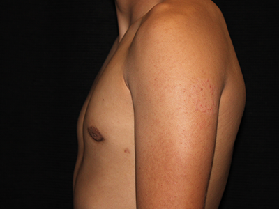 Patient #30815: Gynecomastia with Liposuction After Image