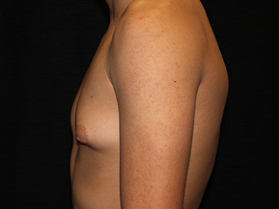 Patient #30815: Gynecomastia with Liposuction Before Image