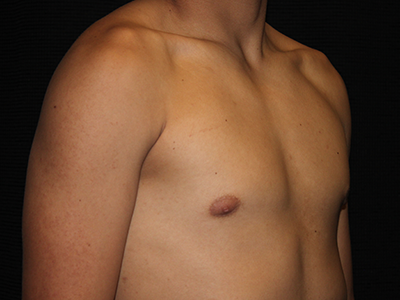 Patient #30815: Gynecomastia with Liposuction After Image