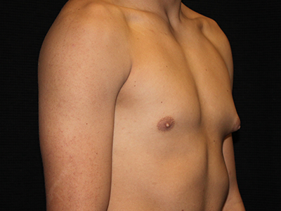 Patient #30815: Gynecomastia with Liposuction Before Image