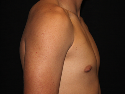 Patient #30815: Gynecomastia with Liposuction After Image