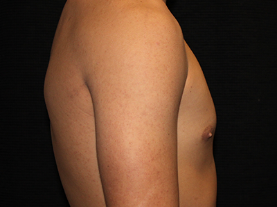 Patient #30815: Gynecomastia with Liposuction Before Image