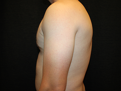 Patient #38420: Gynecomastia After Image