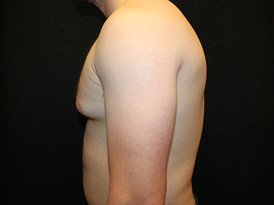 Patient #38420: Gynecomastia Before Image