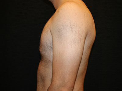 Patient #28706: Gynecomastia After Image