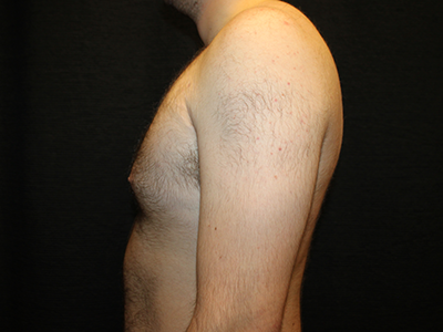 Patient #28706: Gynecomastia Before Image