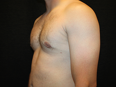 Patient #38420: Gynecomastia After Image