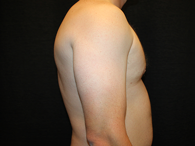 Patient #38420: Gynecomastia After Image