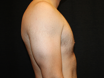 Patient #28706: Gynecomastia After Image