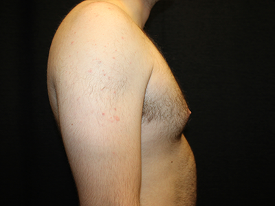 Patient #28706: Gynecomastia Before Image