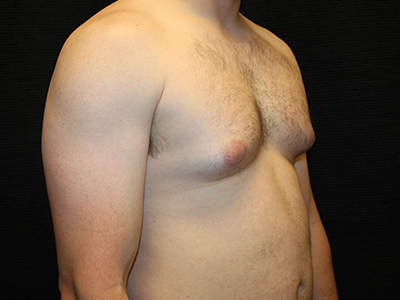 Patient #38420: Gynecomastia Before Image