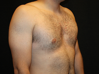 Patient #28706: Gynecomastia After Image