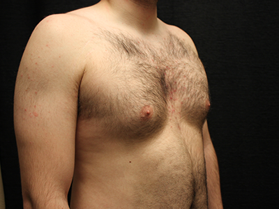 Patient #28706: Gynecomastia Before Image