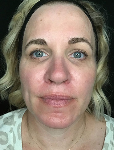 Patient #92997: Liquid Facelift After Image