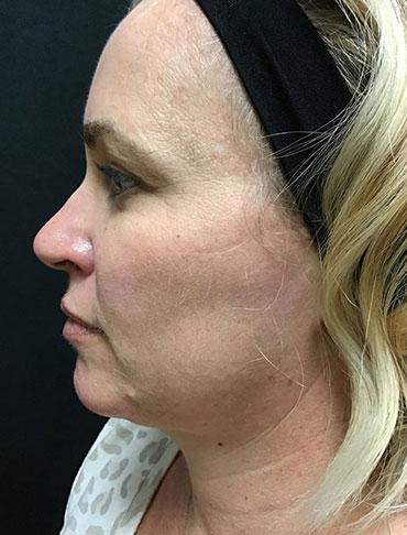 Patient #92997: Liquid Facelift After Image