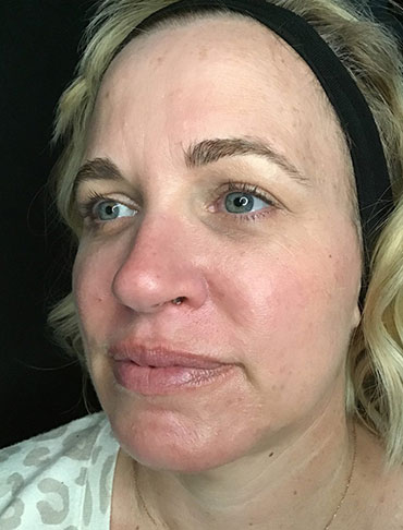 Patient #92997: Liquid Facelift After Image