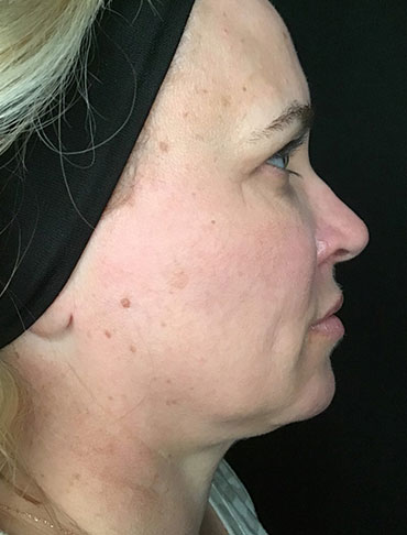 Patient #92997: Liquid Facelift After Image