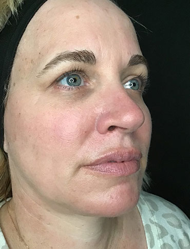 Patient #92997: Liquid Facelift After Image