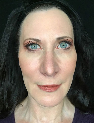 Patient #65054: Liquid Facelift After Image